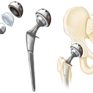 Hip Replacement Treatment in Pune.