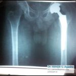 Total Knee Replacement