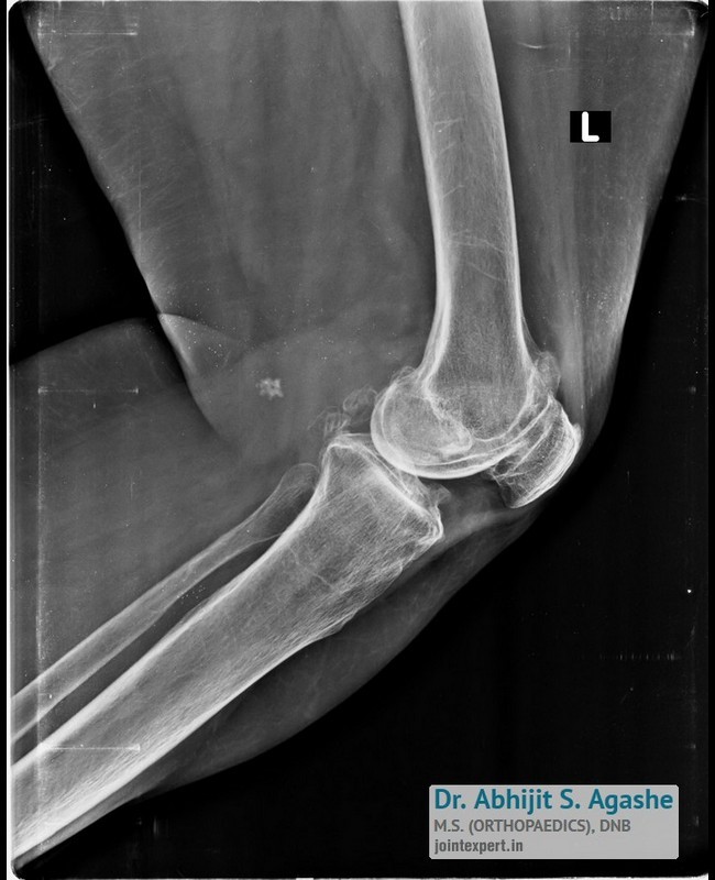 Total Knee Replacement