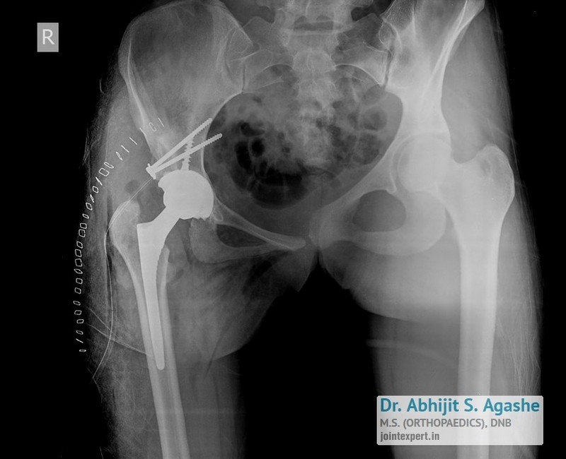 Total Knee Replacement