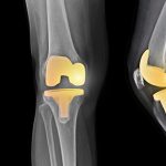 Total Knee Replacement