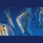 Total Hip Replacement