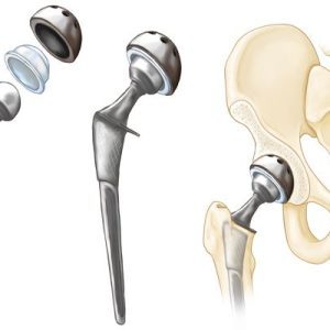 2-featured-compressed-total-hip-3-illustration-compressor-pqqkocb2zauof454hvz3p3vetsv3vebooic3ivix14